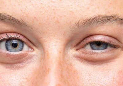 Getting Rid Of Ptosis Easily