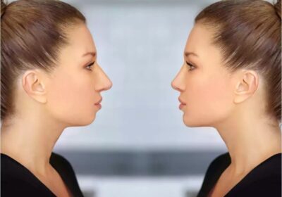 The Power of a Strong Jawline: Benefits of Chin Implant Surgery