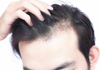 How to solve Male Pattern hair loss