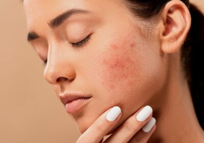 5 Effective ways to treat acne safely and naturally