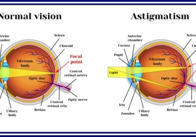 Revolutionizing Vision: Can Astigmatism Patients Opt for LASIK?