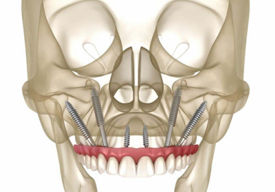 What Is a Zygma Dental Implant?