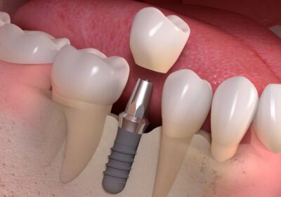 Replacing Missing Teeth: The Benefits of Dental Implants in Edinburgh