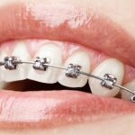 Invisalign Advantages for Straightening Teeth