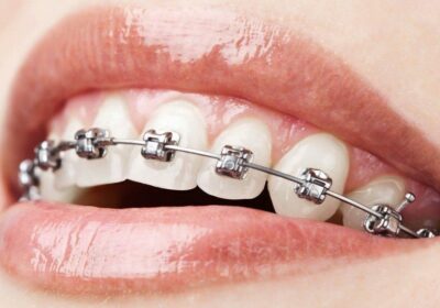 Orthodontist vs. Dentist: Understanding the Differences in Dental Care