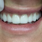 Why Porcelain Veneers Are Worth Considering