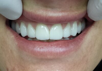 Understanding the Benefits of Porcelain Veneers