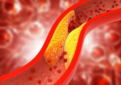 Atherosclerosis Awareness: Spreading Knowledge and Prevention