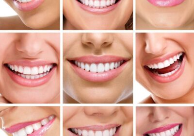 Is Dental Veneer a Permanent Cosmetic Dentistry Service?