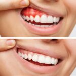 Comprehensive Guide to Periodontal Disease: Prevention, Symptoms, and Effective Treatments