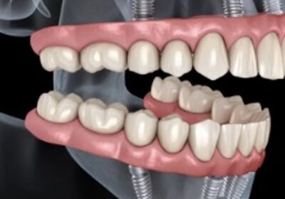 The Revolutionary Solution: All in 4 Implants for a Perfect Smile