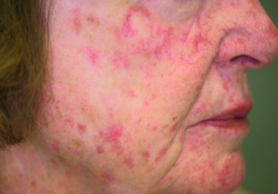 Points to Understand and Treat Basal Cell Carcinoma with Curaderm BEC5 Cream