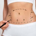 Tummy Tuck vs. Liposuction: Which is Perfect for You?