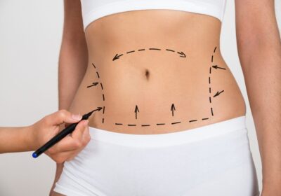 Tummy Tuck vs. Liposuction: Which is Perfect for You?