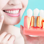 The true cost of teeth implants: what you need to know before your procedure