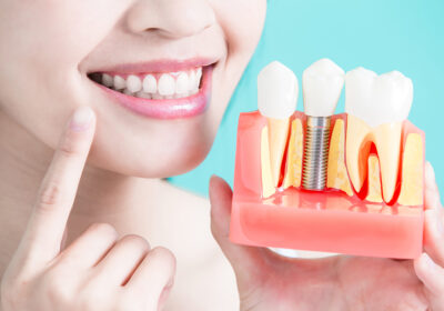 The true cost of teeth implants: what you need to know before your procedure