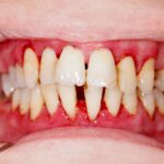 Is Bleeding Gums a Sign of Gum Disease? What You Need to Know