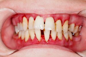 Is Bleeding Gums a Sign of Gum Disease? What You Need to Know