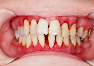 Is Bleeding Gums a Sign of Gum Disease? What You Need to Know