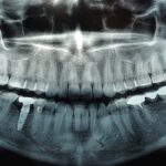 Dental X-Rays: Are They Safe?