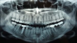 Dental X-Rays: Are They Safe?