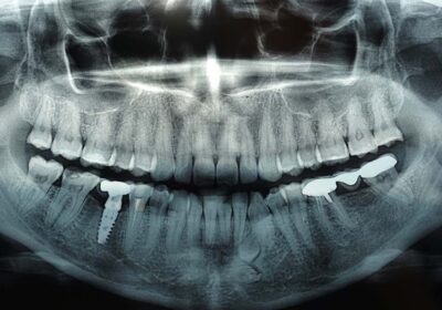 Dental X-Rays: Are They Safe?