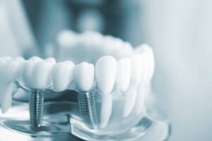 The Benefits Of Dental Implants Over Other Tooth Replacement Options