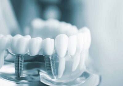 The Benefits Of Dental Implants Over Other Tooth Replacement Options