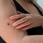 What Is Melanoma? Signs, Symptoms, and Treatment Options