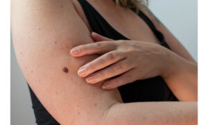 What Is Melanoma? Signs, Symptoms, and Treatment Options
