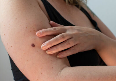 What Is Melanoma? Signs, Symptoms, and Treatment Options