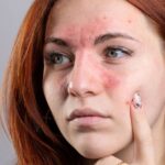 Managing Rosacea: Treatment Benefits for Skin Health