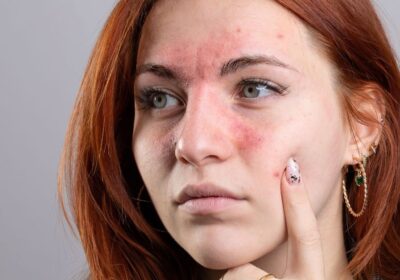 Managing Rosacea: Treatment Benefits for Skin Health