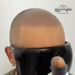 Scalp Micropigmentation: A Confidence-Boosting Hair Loss Solution