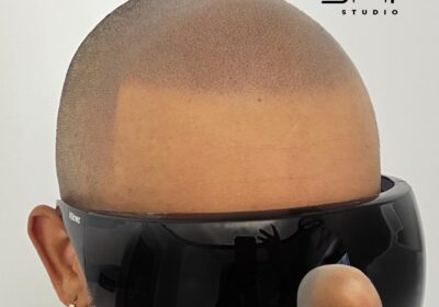 Scalp Micropigmentation: A Confidence-Boosting Hair Loss Solution Scalp Micropigmentation: A Confidence-Boosting Hair Loss Solution
