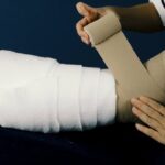 Lymphedema Treatment with Multi-Layered Compression