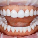 The Smile Timeline: From First Exam To Final Touch Up