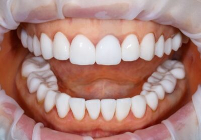 The Smile Timeline: From First Exam To Final Touch Up