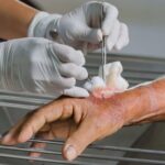 What Is Sharp Debridement and How Does It Help?