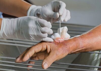 What Is Sharp Debridement and How Does It Help? What Is Sharp Debridement and How Does It Help?